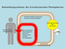 Behandlungsschema ECP