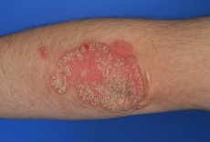 psoriasis