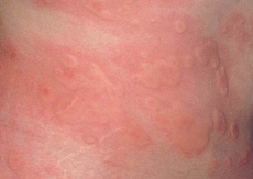 urticaria