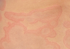 urticaria